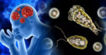 brain-eating amoeba infection